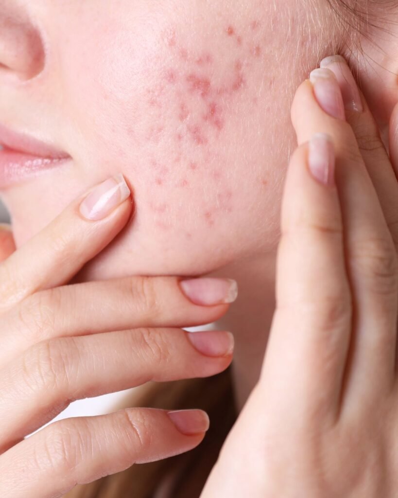 Liječenje Akni Varaždin Vivaderm